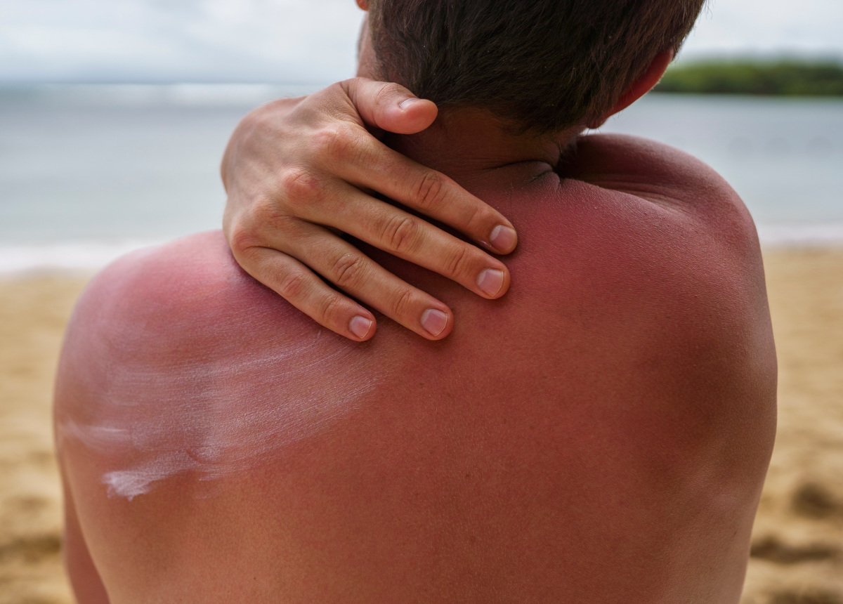 La pelle non dimentica: come prevenire i tumori cutanei 