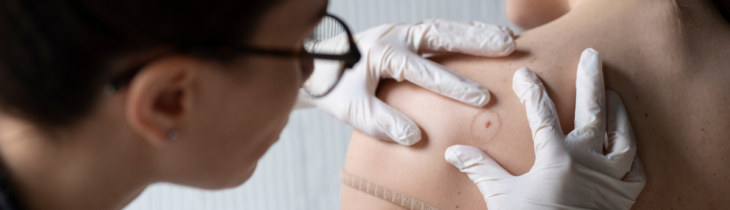 Melanoma, arriva il vaccino personalizzato: rivoluzione o entusiasmo prematuro? 